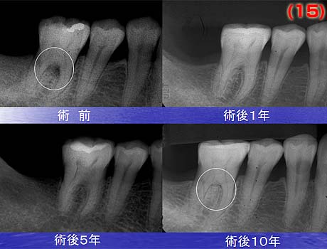歯周病治療の術前術後